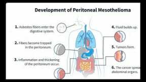 Mesothelioma Attorney | Top Mesothelioma Law Firms | mesothelioma Personal Injury Lawyers